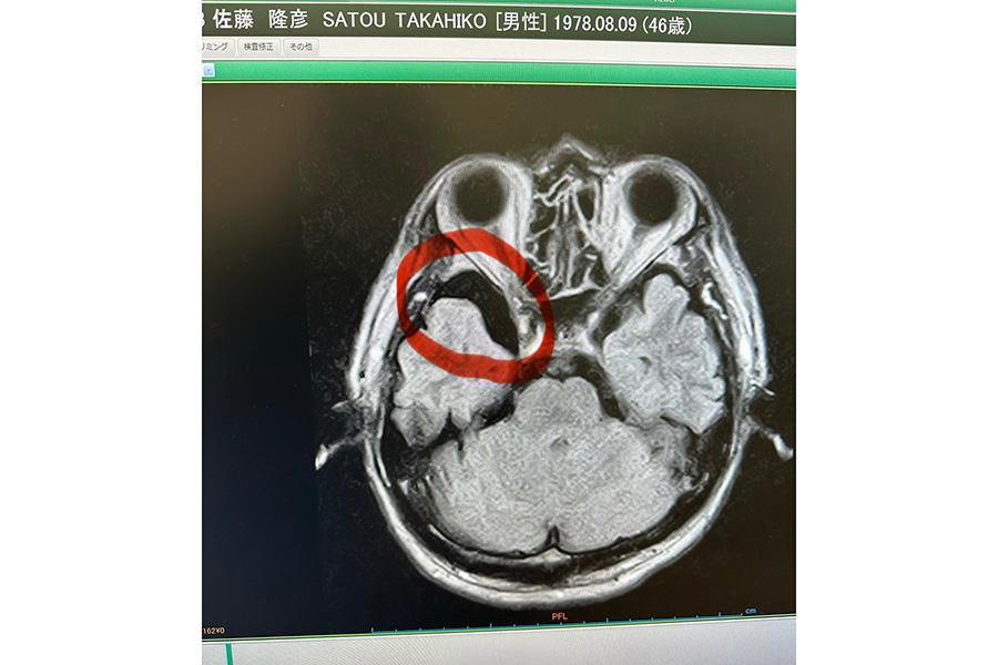 G.G.佐藤氏がXに投稿したMRI画像（写真はスクリーンショット）